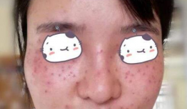 激光祛斑视频全过程,安全高效，美丽蜕变